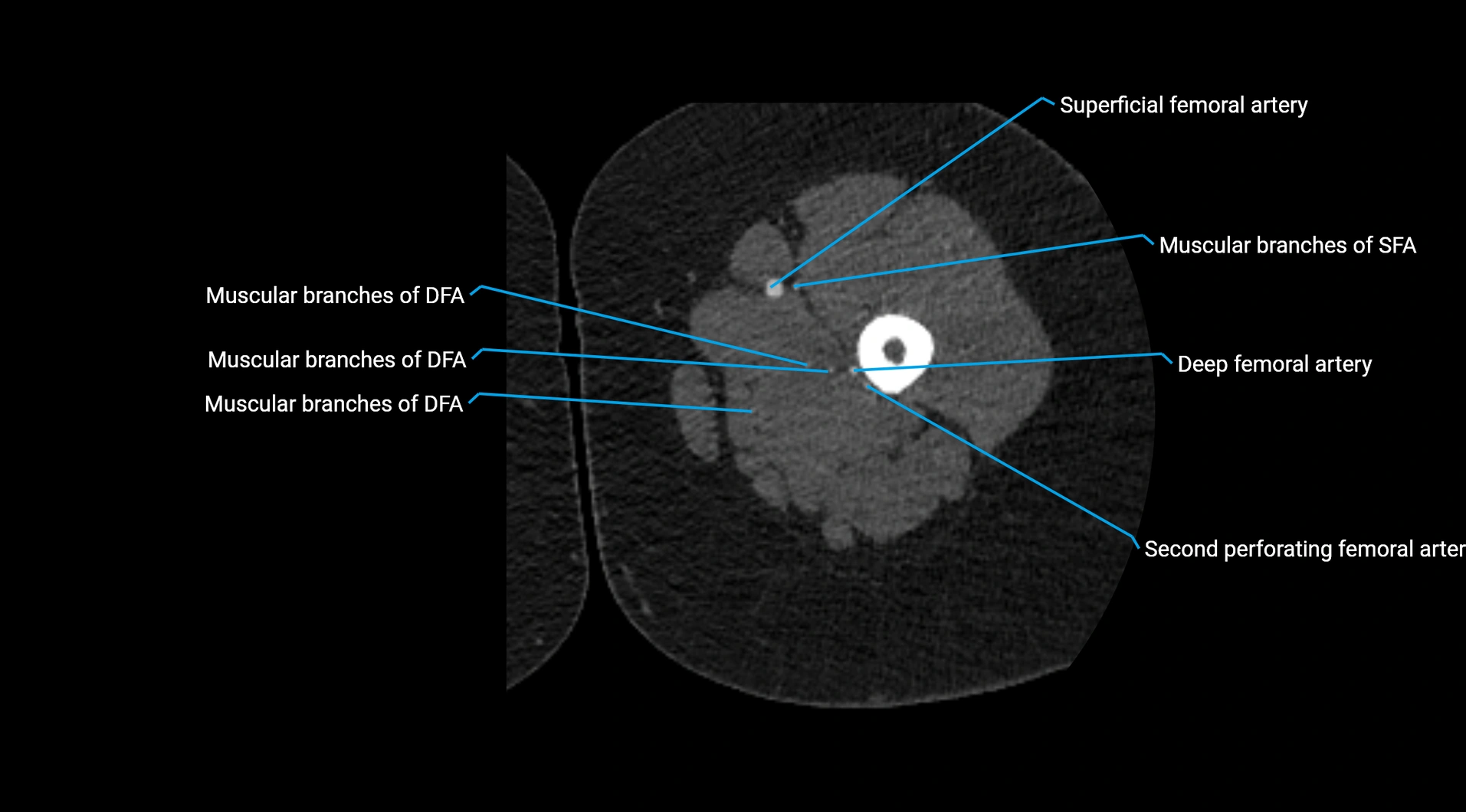 CTA lower limb cross sectional anatomy labelled image _109.webp